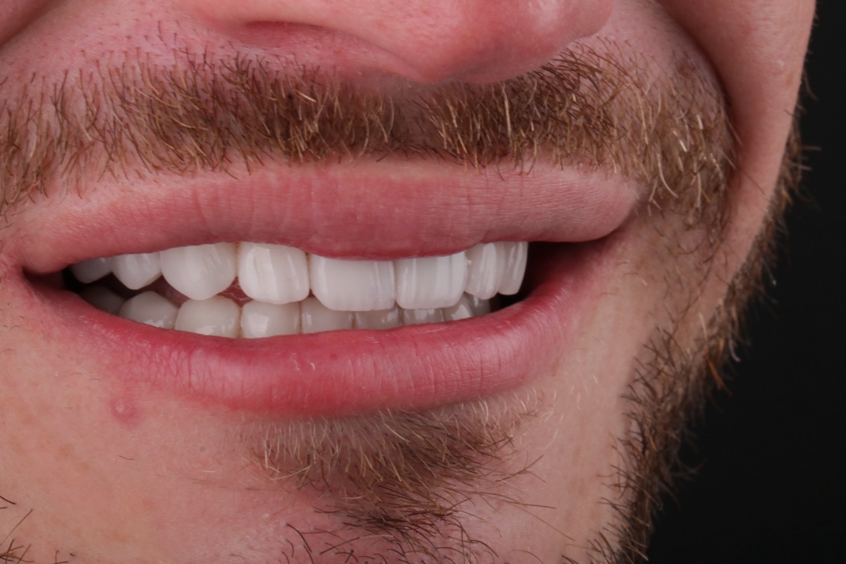After no-prep veneers - Alexis
