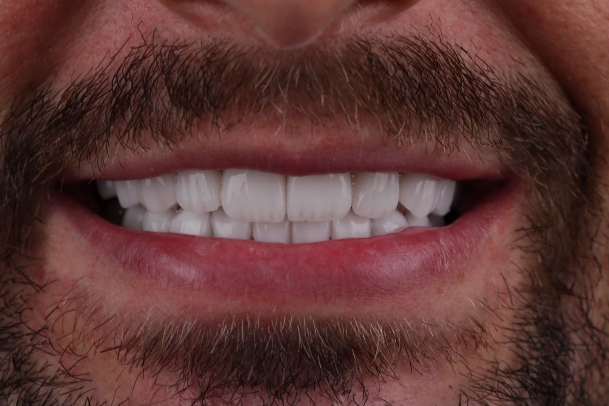 After no-prep veneers - Antony