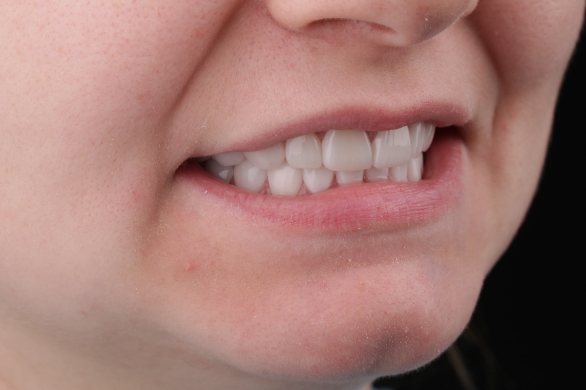 After no-prep veneers - Cassandra