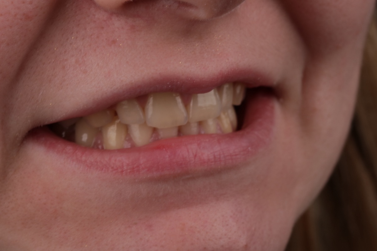 Before veneers - Cassandra