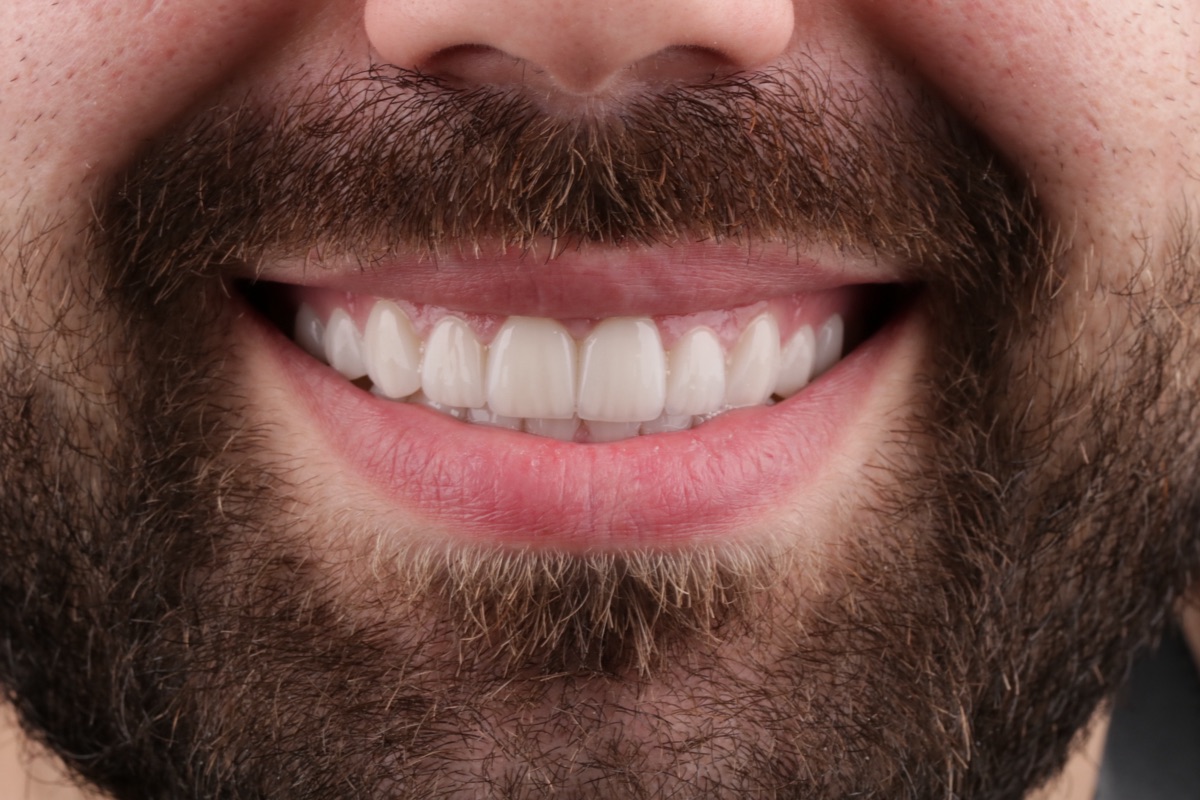 After no-prep veneers