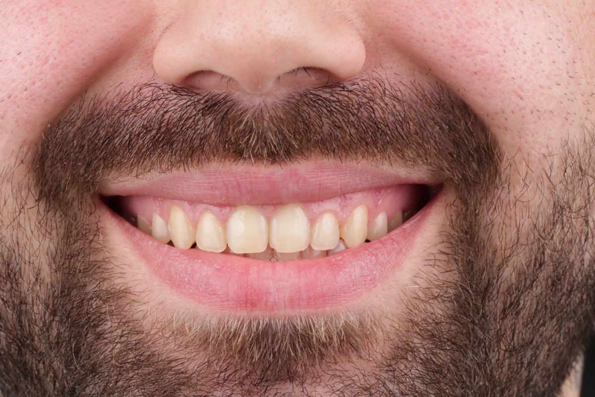 Before veneers