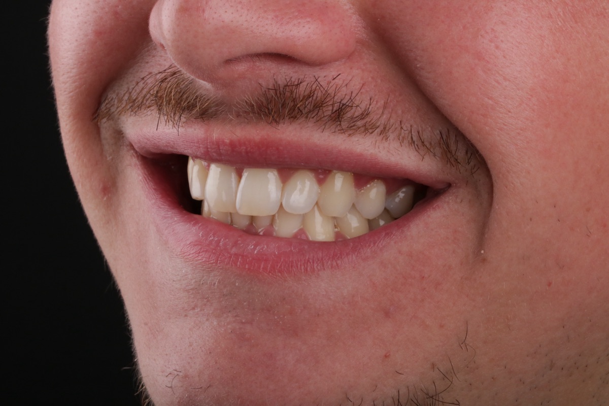 Before veneers - Florian