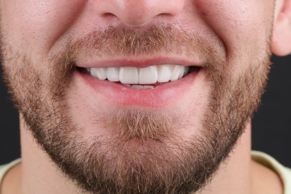 After no-prep veneers - Franciase