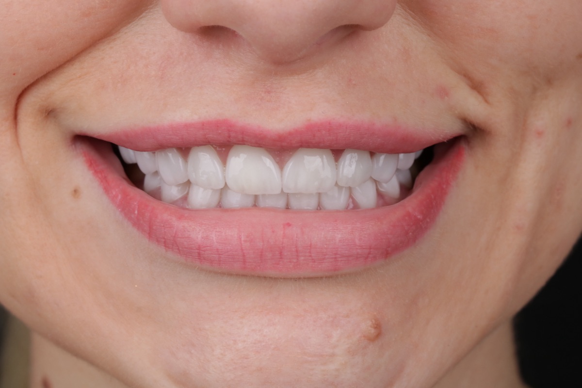 After no-prep veneers - Kerry