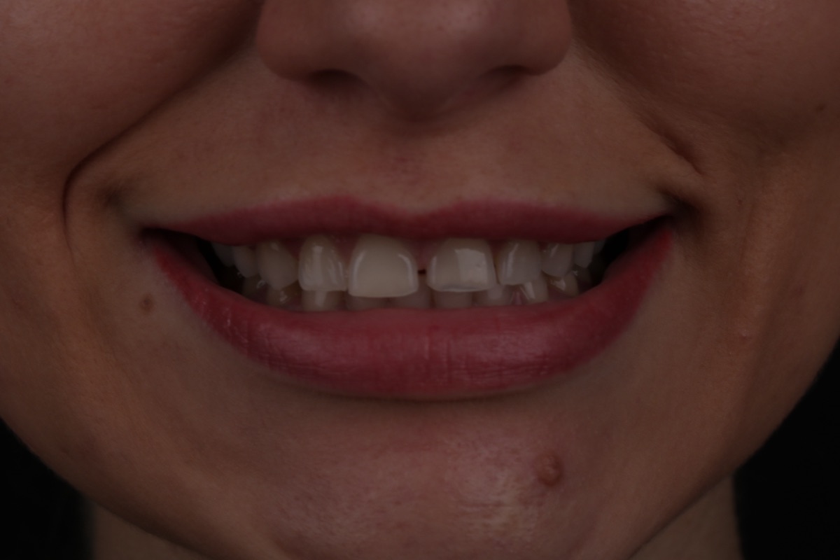 Before veneers - Kerry