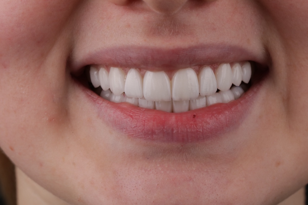After no-prep veneers - Lea