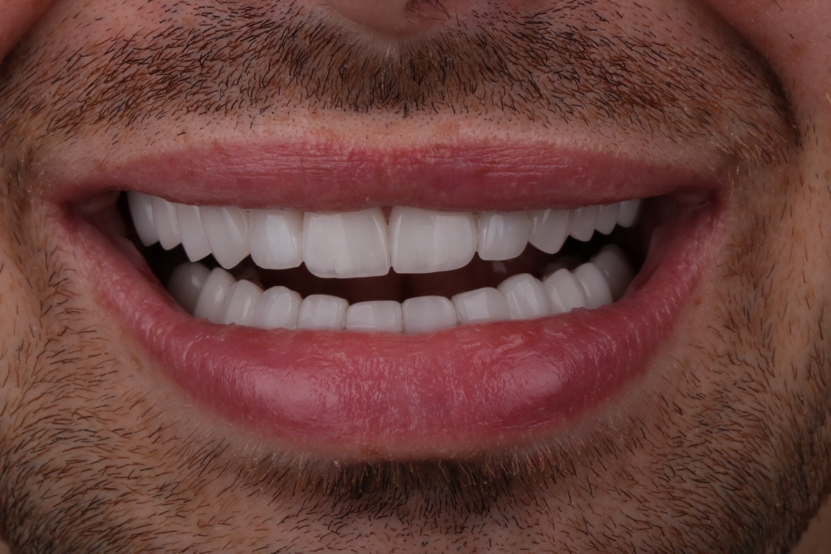 After no-prep veneers - Loup