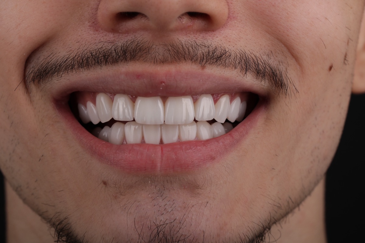 After no-prep veneers - Nhat Leo