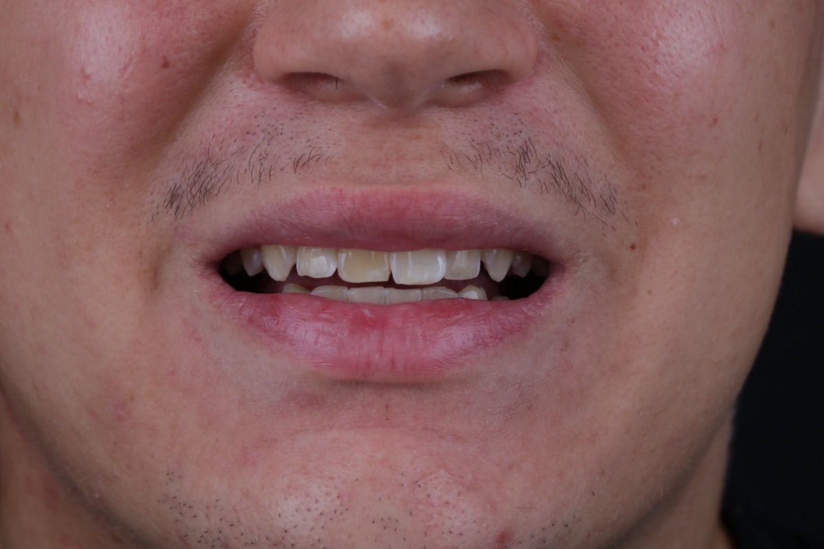 Before veneers - Noah