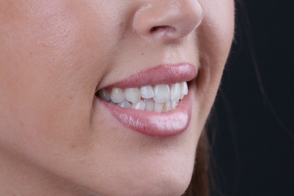 Before veneers - Sephora