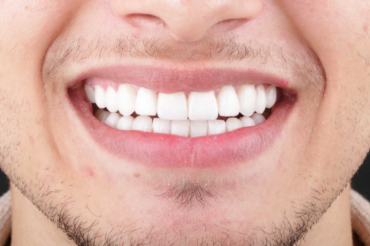 After no-prep veneers - Yohan