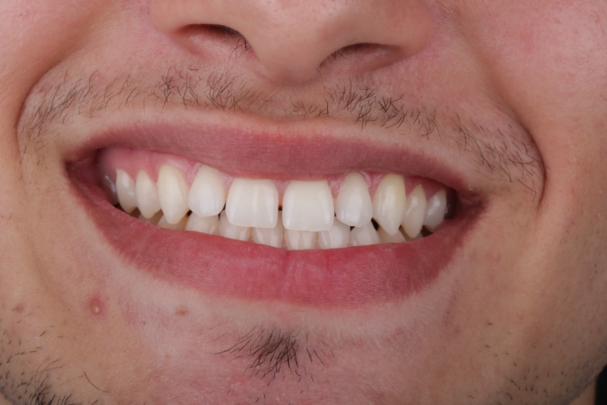 Before veneers - Yohan
