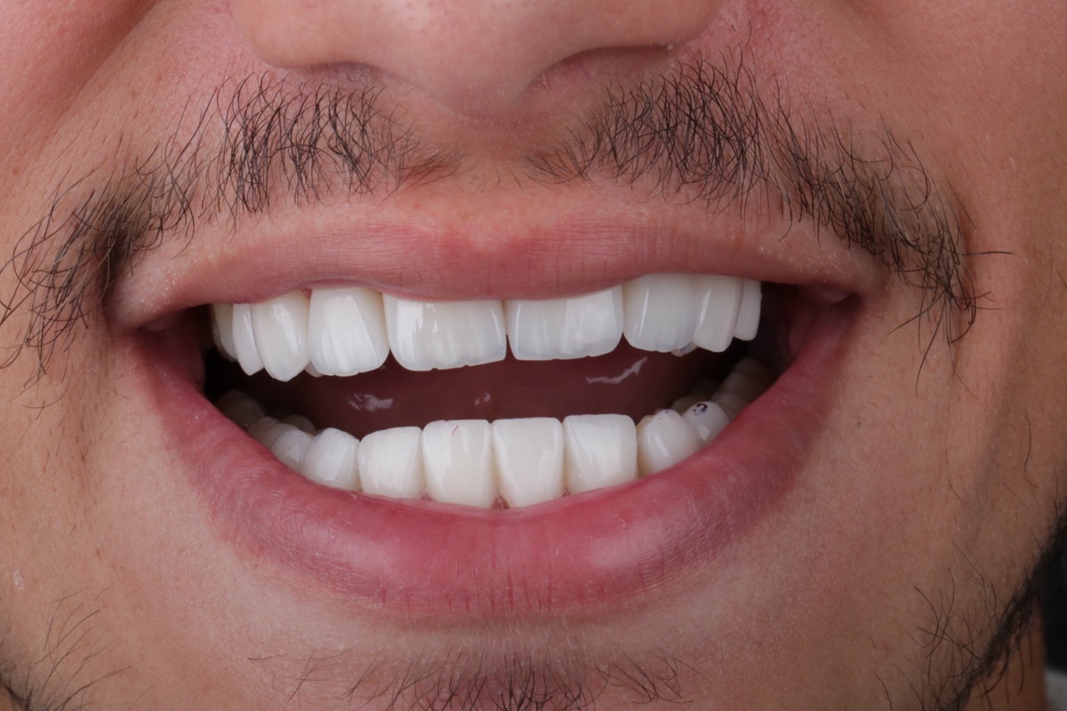 After no-prep veneers - Zinedine