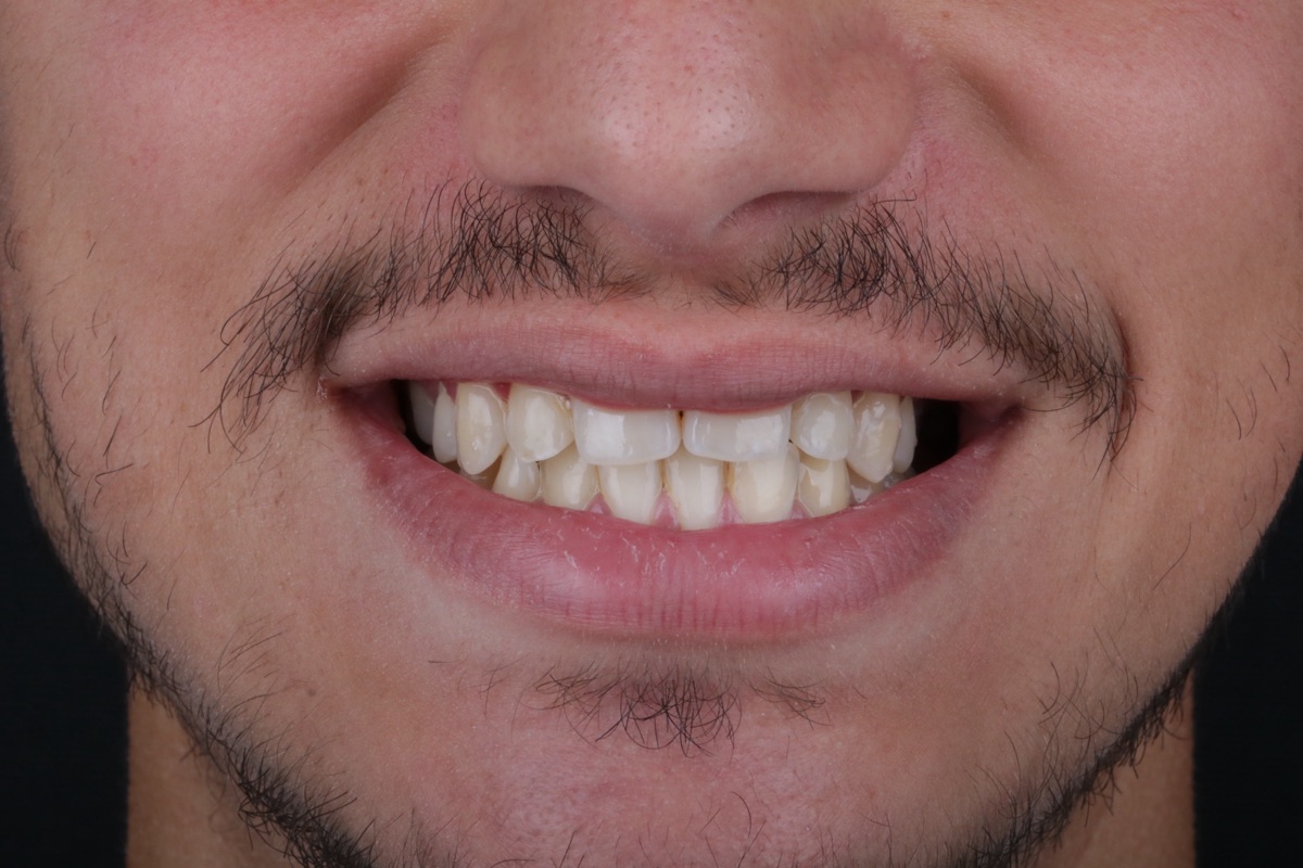 Before veneers - Zinedine